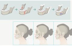 正颌手术