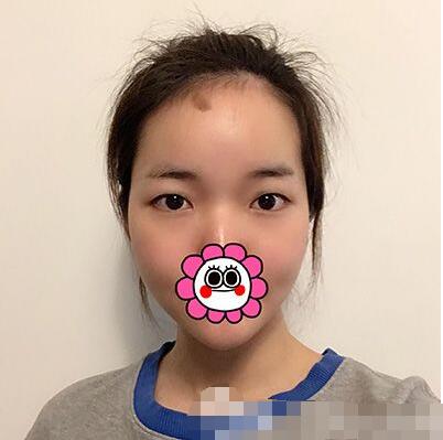 上海华美整形美容医院双眼皮案例图