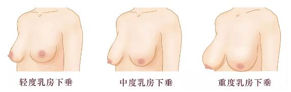 乳房下垂分为轻、中、重三度