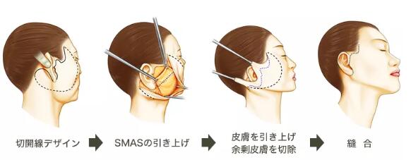 觉得拉皮除皱手术的适宜人群：主要是40-65岁