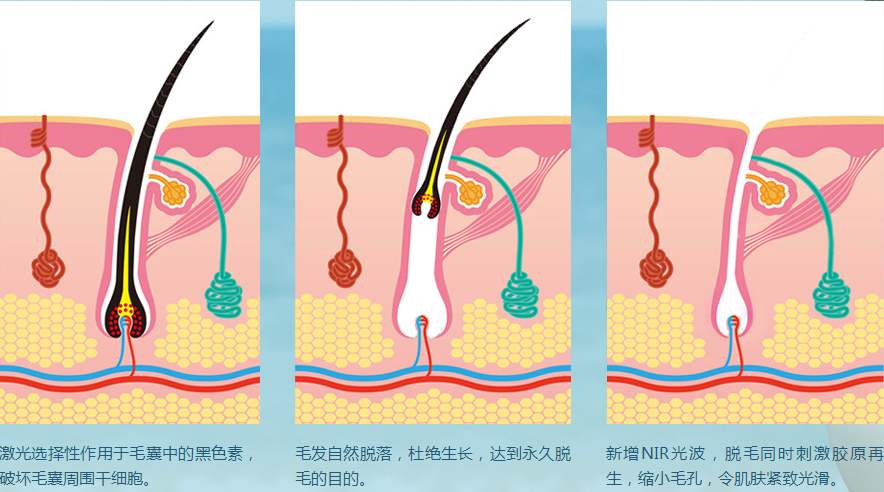 全身脱毛对身体有危害吗？适合用哪种方式？