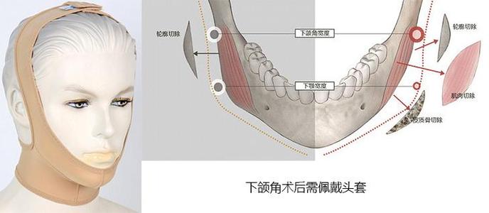 术前必看丨下颌角截骨费用，选对医生很重要~