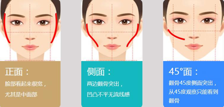 【术前必看】颧骨内推术后有啥后遗症没？