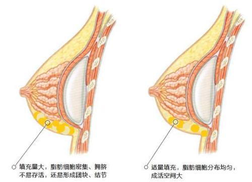 上海艺星脂肪隆胸技术丨大咖医生亲诊~