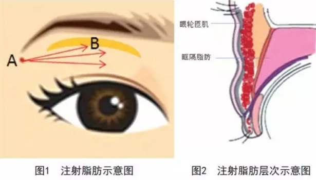 自体脂肪填充眼窝，五分钟解决眼窝凹陷问题！