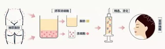 自体脂肪移植丰鼻唇沟果如何？看图就知道了！