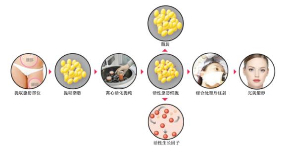 脂肪填充脸颊多久变软？术后触感多久能变真实？