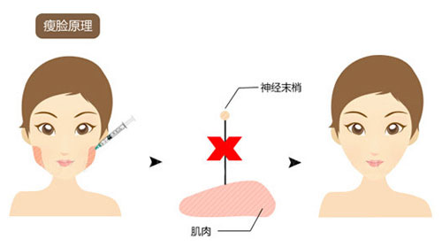 肉毒毒素瘦脸原理