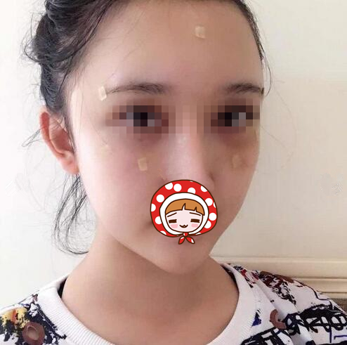 广州佳人医疗美容整形门诊部脂肪填充案例