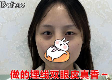 佛山华美整形医院双眼皮案例