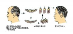 什么是头发种植？术后容易脱落吗？来看详细介绍